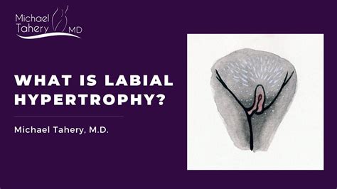 large labi|Labial Hypertrophy: Symptoms, Treatment, and More .